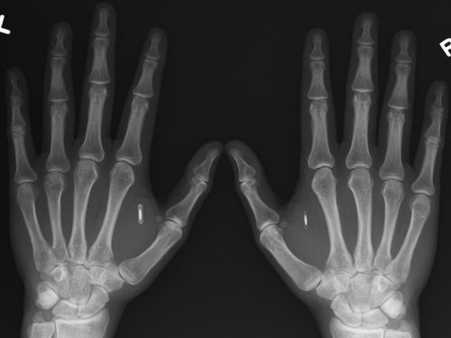 Nfc-tag-implant.jpg